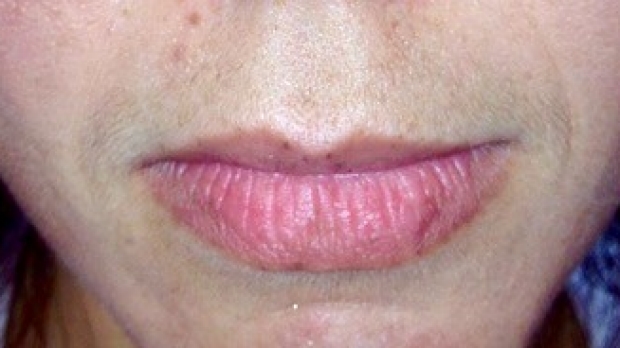 25-34 year old woman before Lip Augmentation