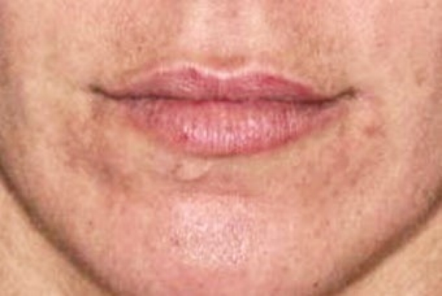 35-44 year old woman before lip augmentation