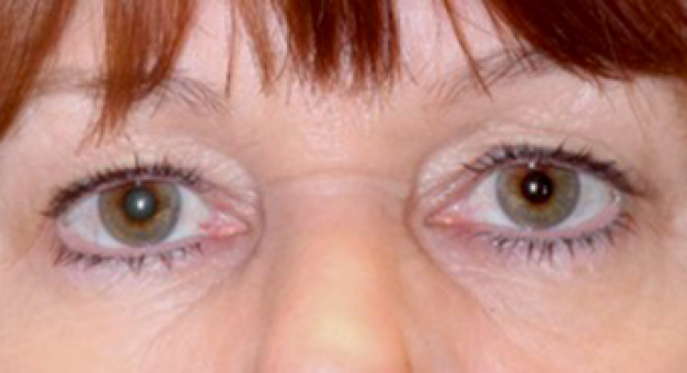 55-64 year old woman before Bilateral Upper Lid Blepharoplasty and Endoscopic Browplasty