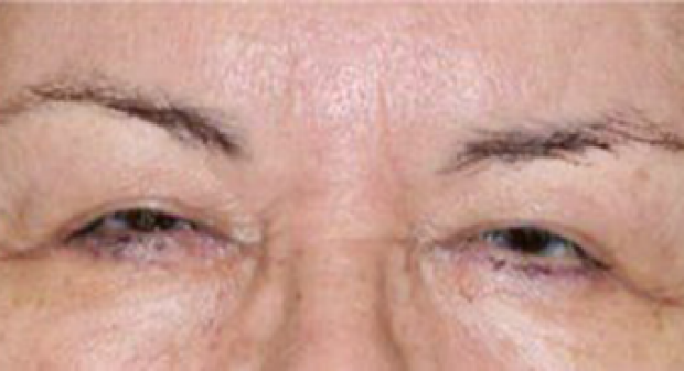65-74 year old woman before Eyelid Surgery