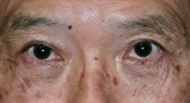 65-74 year old male treated with Eye Bags Treatment