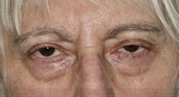 65-74 year old woman before Eye Bags Treatment
