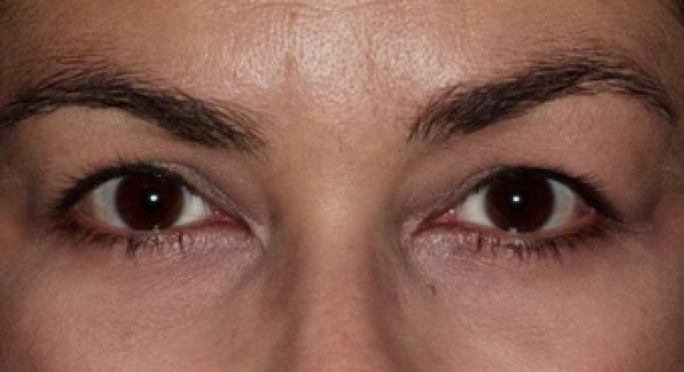 45-54 year old woman treated with Ptosis Surgery