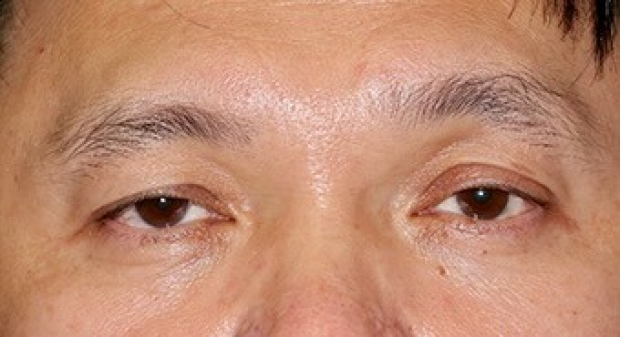 Before photo of patient's eyes