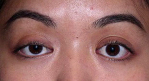 25-34 year old woman before Ptosis Surgery
