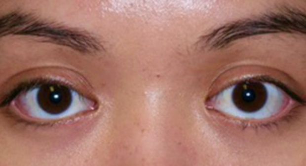 25-34 year old woman treated with Ptosis Surgery