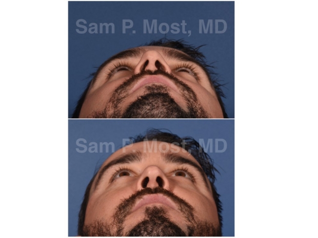 Sam P. Most - Primary Rhinoplasty
