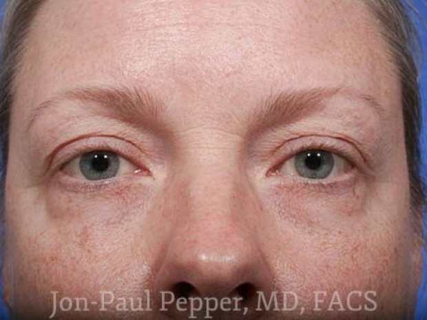 upper-lip-blepharoplasty-front-before