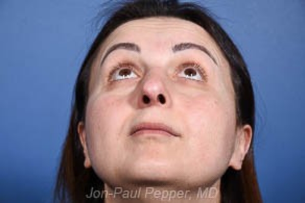 8-revision-rhinoplasty-upview-after
