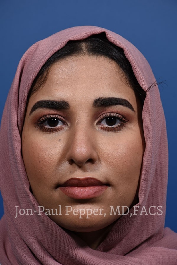 rhinoplasty front after