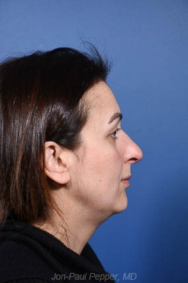2-revision-rhinoplasty-profile-after