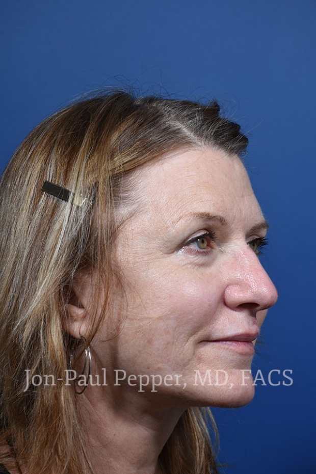 laser resurfacing IPL scar revision patient 45 degree right before