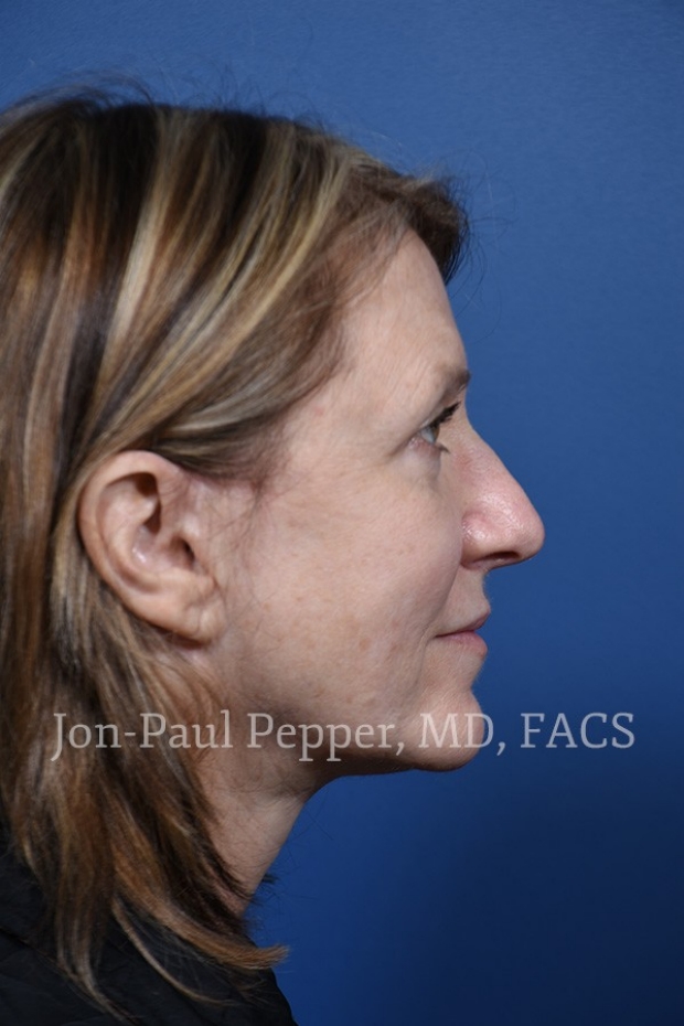 laser resurfacing IPL scar revision patient right profile after