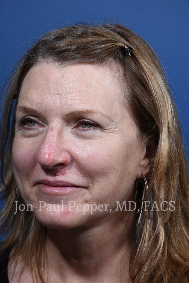 laser resurfacing IPL scar revision patient 45 degrees left before