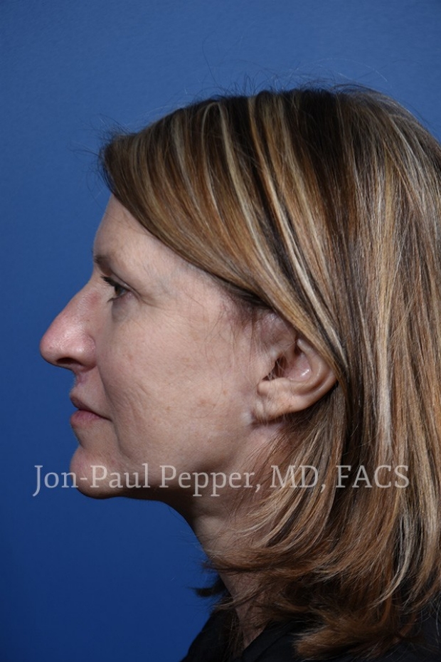 laser resurfacing IPL scar revision patient profile left after