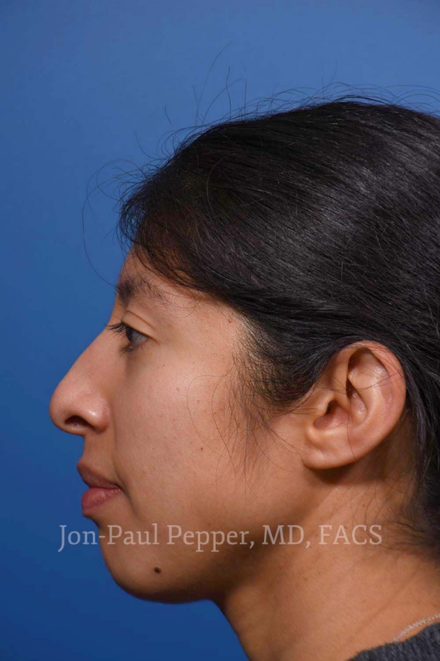 Rhinoplasty lateral before