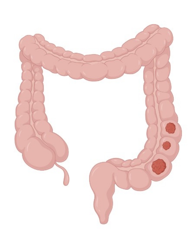 Image of a large intestine