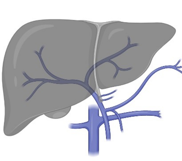 Drawing of a liver to be transplanted