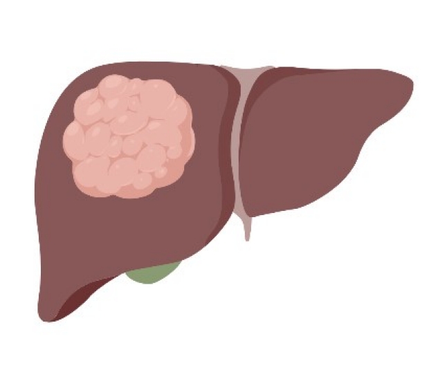 Drawing of a liver with a tumor on it
