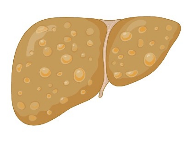 Drawing of a Fatty Liver