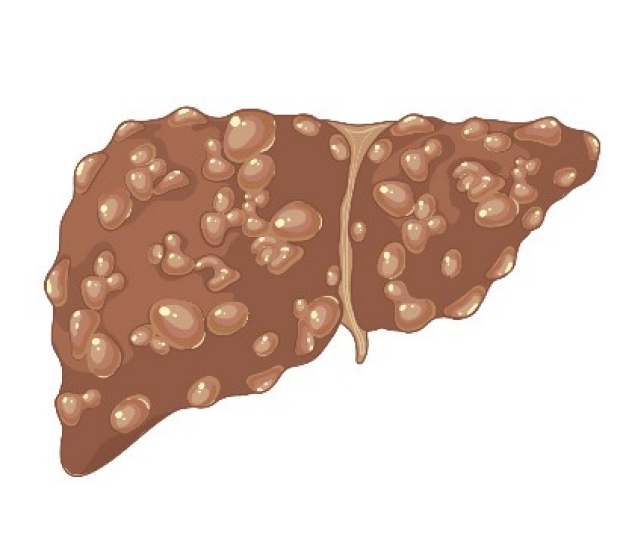 Drawing of a liver with cirrhosis