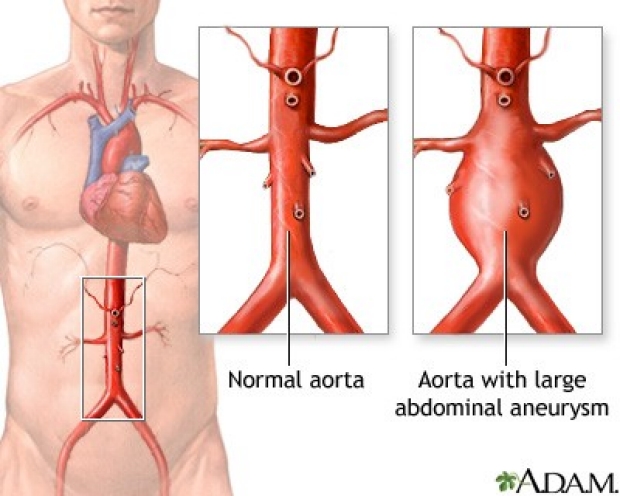 Normal aorta compared to aorta with large abdominal aneurysm