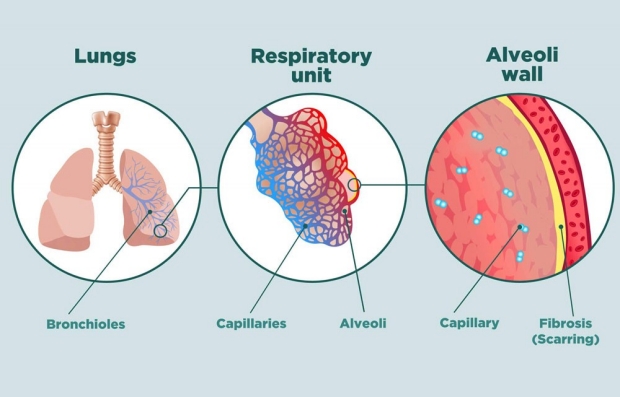 Visual representation of fibrosis in the lung