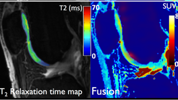 Quantitative Imaging of Bone-Cartilage Interactions in ACL-Injured Patients with PET-MRI 