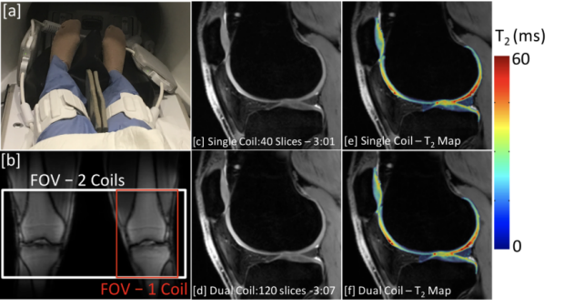 Bilateral Knee MRI