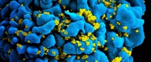 Electron micrograph HIV