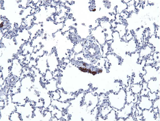 Neuroendocrine cells in lung disease