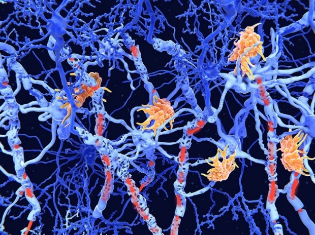 An artist’s impression of nerve cells (blue) showing damage (red) caused by the degenerative disease multiple sclerosis.Credit: Juan Gaertner/SPL