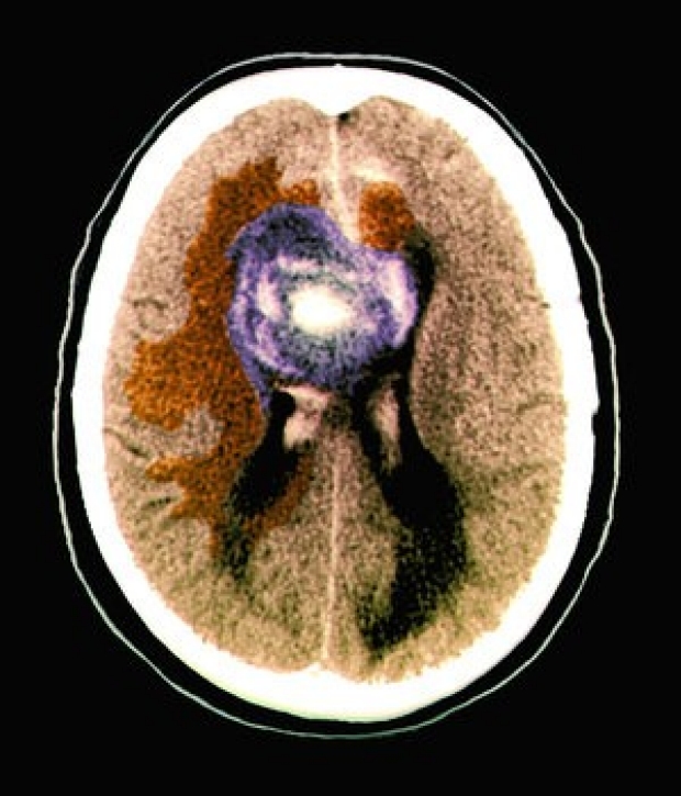 A computerized tomography scan shows part of the brain of a 59-year-old patient with a malignant glioblastoma brain tumor. Researchers say certain brain cancers tap electrical signals from healthy cells to fuel their growth. 