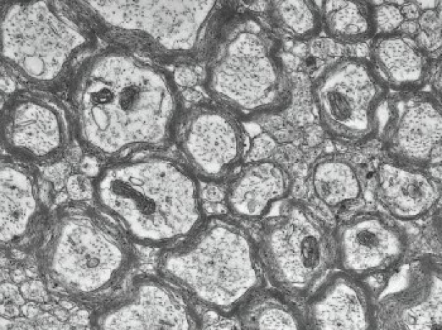 two electron micrographs showing myelinated axons from the brains of mice with seizures (Scn8a+/mut) or without seizures (Scn8a+/+). The mice with seizures have an increased proportion of myelinated axons and some axons with thicker myelin sheaths. 