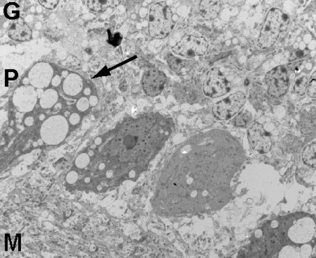 Reimer Lab Electron micrographs of P21 cerebellum  from control (left) and sialin knockout mouse.  Arrows identify Purkinje cells containing electron lucent vacuoles.  