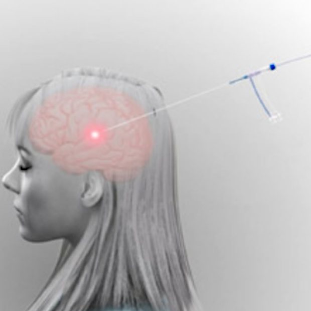 Laser Ablation Surgery Stanford Epilepsy