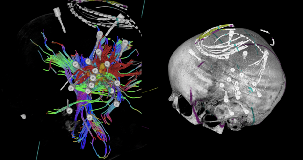 tractography for epilepsy