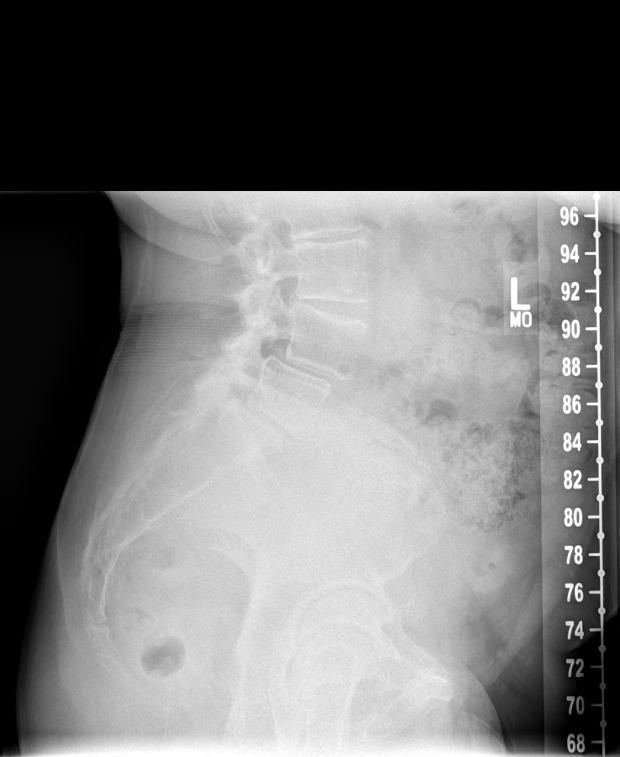 robotics spinal fusion pre-operative x-ray