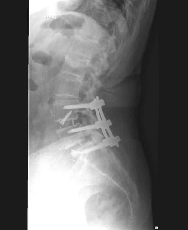 robotics spinal fusion post-operative x-ray