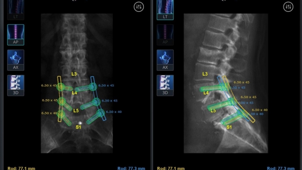 Neurosurgery_neurospine_robotics_scan_spine