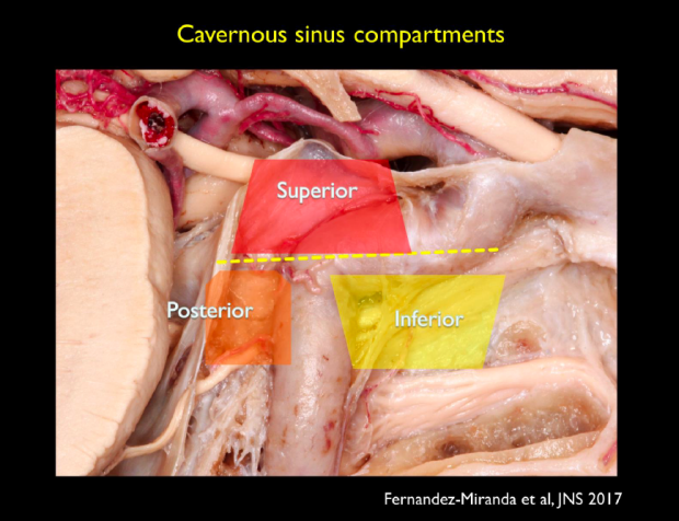 Pituitary Adenoma Cavernous Sinus