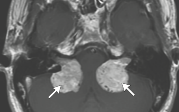 neurofibromitosis scan