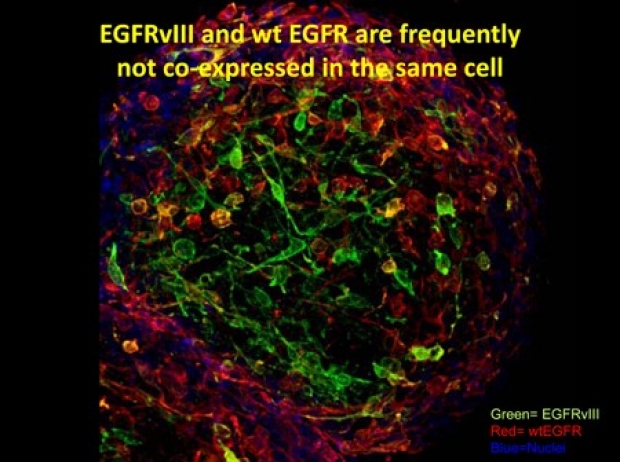 Wong Lab Research EGFRvIII and wt EGFR are frequently not co-expressed in the same cell