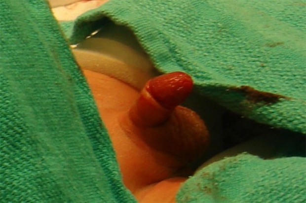 The penis immediately after circumcision.