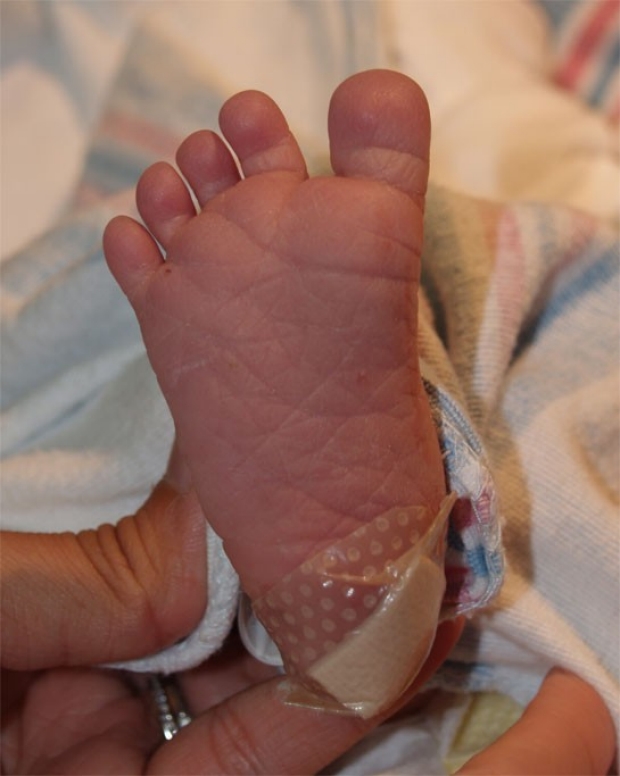 Pekkadillo veronderstellen Bloeden Dysmorphology | Newborn Nursery | Stanford Medicine