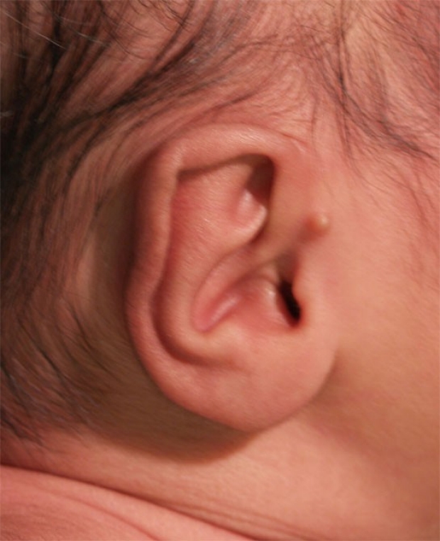 Normal Ear
