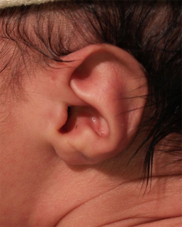 Ear Pit