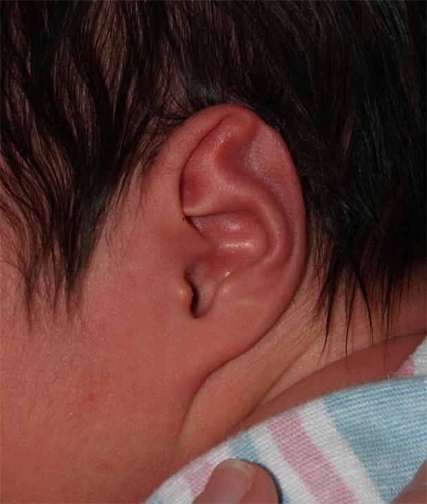 Stahl's Ear