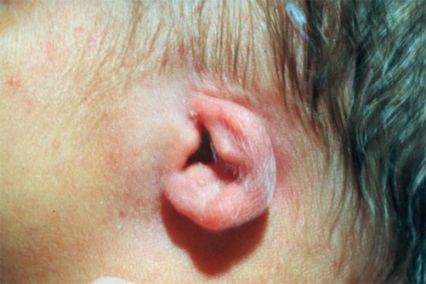 Hypoplastic Ear