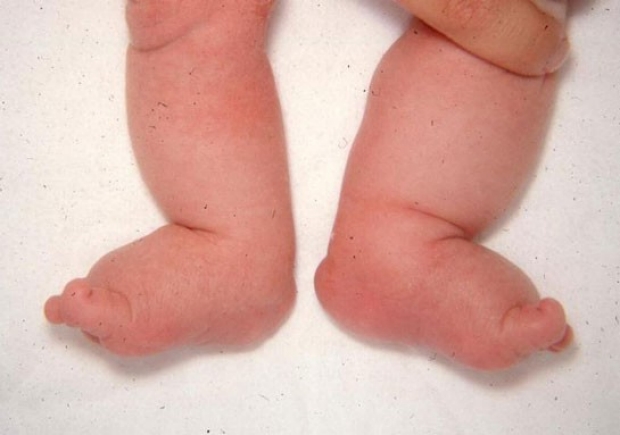 Edema of the Feet